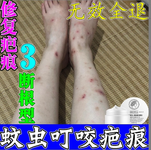 夏季腿部蚊虫叮咬疤痕止痒祛肿包婴儿儿童蚊子咬疤淡印特效祛痕膏