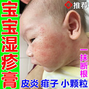 婴宝湿疹婴儿专用宝宝湿疹膏无激素儿童特应性皮炎止痒专用痱子粉
