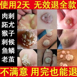 医敷雀点痣膏疣克舒软膏疣清正品官方旗舰店脚疣去除神器鸡茧疣