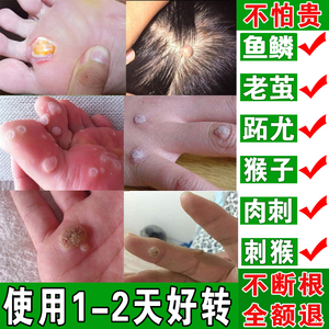 刺猴扁平疣,刺猴跖疣(第13页)_大山谷图库