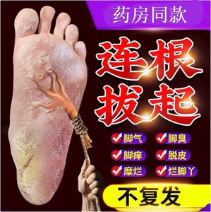 治疗脚气小孩止痒膏皮肤瘙痒感染真菌孕妇去水泡脱皮灰指甲癣药膏