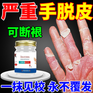 治疗手脱皮的药膏手指真菌感染手心手脚干裂起皮掉皮脱皮止痒专用