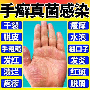 手癣膏脱皮干裂真菌感染手足癣鹅掌风烂手指干裂治贴手上小水泡TF