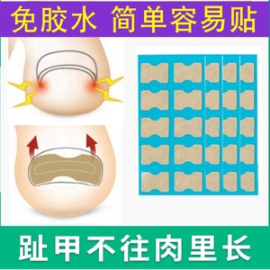 正甲贴甲沟嵌甲矫正器炎脚沟脚趾趾甲贴片纠正指甲长肉里神器套装