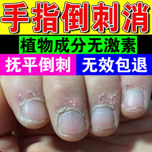 指甲修复液手指倒刺营养油护理去刺神器防止儿童手上长边缘干裂霜