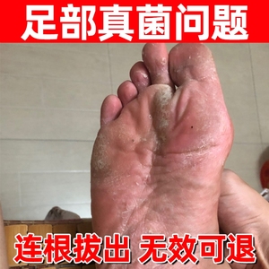 足光粉去臭脚苗本草脚气止痒泡脚正品脚气专用药治疗脚痒真菌感染