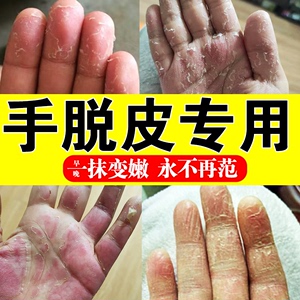 手脱皮修复霜季节性手掌手指头蜕皮严重干裂维生素褪起皮掉皮爆皮