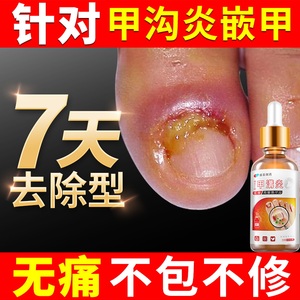 日本甲沟炎软甲息肉去除专用软化剂治疗手指甲脚趾头神器化脓膏