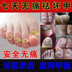 进口药水抗菌抗真菌神器日本去灰指甲专用药小林抑菌液正品灰指甲