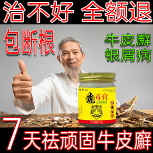 牛皮藓癣银屑病股癣手足头皮癣湿疹止痒治疗皮肤瘙痒专用特效药膏