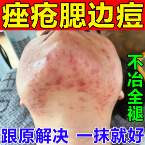 去淋巴痘腮边痘下巴痤疮腮帮子脸颊两边脖子长痘根祛重度暗疮药膏