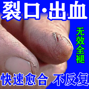 手裂口干裂修复霜秋冬季指甲缝干裂手指裂口子老年人手开裂皲裂膏