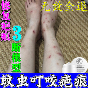 夏季腿部蚊虫叮咬疤痕止痒消肿包婴儿儿童蚊子咬疤淡印特效祛痕膏