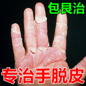 手脱皮起皮专用膏药真菌感染手上爆皮干燥脱皮手裂开干裂止痒软膏