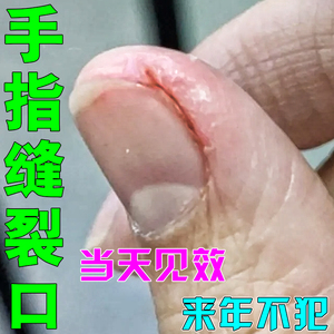 手裂口干裂修复霜秋冬指甲缝干裂防手指裂口开裂脱皮瘙痒真菌感染