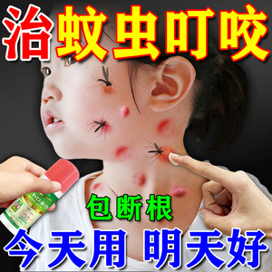 儿童专用蚊虫叮咬快速止痒消肿膏婴幼儿宝宝成人药膏夏季日本神器