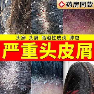 头皮屑严重去头屑头痒癣专用治毛囊炎药膏特效头部真菌感染