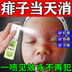 痱子药膏去痱子止痒祛痱儿童成人宝宝婴儿热痱子湿疹止痒根去专用