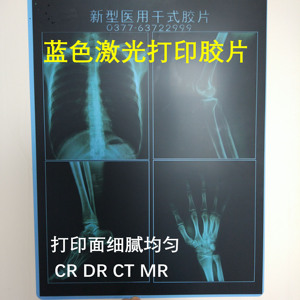 医用蓝色激光胶片CR DR CT胶片X光PET蓝片柯丽尔胶片同款 14×17
