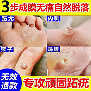 跖疣膏寻常疣病毒拓趾足部根立净疣去除去疣脚底非药房同售专用