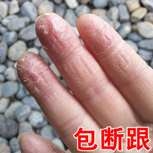 手脱皮严重脱皮专用药膏手指干裂蜕皮真菌感染干燥起皮皲裂护手霜