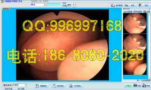 宫腹腔镜软件宫腔镜手术报告腹腔镜软件内窥镜软件支气管镜膀胱镜