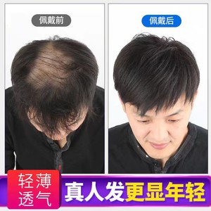 男士头顶假发片真发全真人发假发男短发地中海前额透气男生补发片