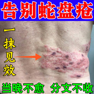 蛇盘疮专用药缠腰龙蛇胆疮蜘蛛疮带状疱疹后遗症神经痛治蛇盘疮药