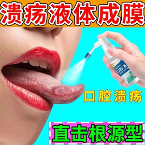 口腔溃疡喷剂的特维生素效凝胶疮贴专用治疗牙膏可搭配膏药贴ZT
