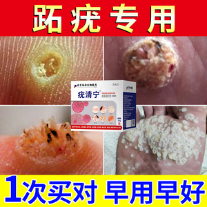 跖疣专用膏去除石疣脚底趾疣血胞刺去鸡眼拓尤必净清尤敷料根DF