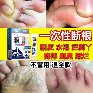 脚气药根治止痒真菌感染水泡治疗脚气烂脚丫脚痒脱皮糜烂专用喷剂
