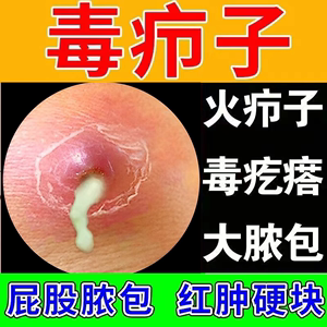 疖肿拔毒膏皮脂腺囊肿火疖子药膏粉瘤去除囊肿屁股上长痘痘坐疮