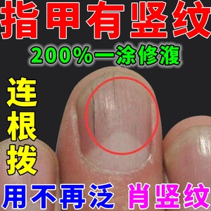 指甲竖纹修复受损手指甲开裂断甲黑线凹凸不平甲肉分离增厚软化液