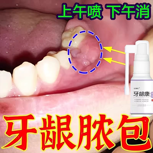 牙龈脓包牙发炎肿痛消炎出血鼓包上火牙周炎专用止痛喷剂