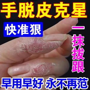 手脱皮严重脱皮专用药膏治手干裂手指真菌感染季节性手脱皮护手霜