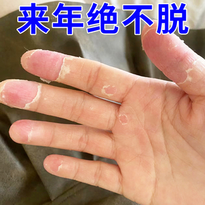 手脱皮严重脱皮专用真菌蜕皮干燥起皮治疗手掌脚底干裂褪皮护手霜