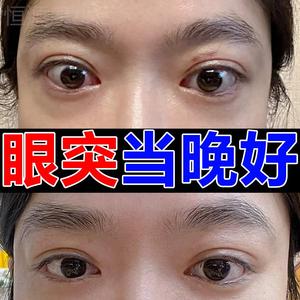 甲亢眼突眼贴专用中药治疗桥本氏眼睛凸近视水肿滴眼液调理眼药水