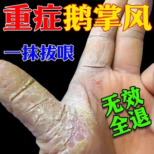 鹅掌风脱皮干裂脚藓手癣真菌感染汗状疱疹手上起小水泡专用软膏药