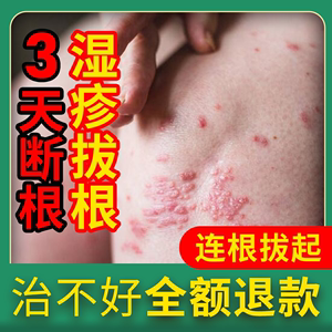 特效百毒王湿疹止痒去顽固根慢性皮炎皮肤瘙痒外用的苗家药膏抑菌