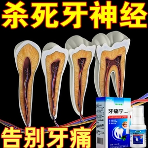 杀死牙神经去牙疼牙痛立可停专用速效牙膏治牙龈肿消痛炎龋齿喷剂