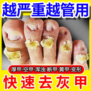 灰指甲特效进口药水脱甲精油一滴甲脚指甲发黄变厚变硬抑菌液