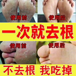 抗真菌脚气药膏止痒脱皮去根神器除脚臭日本感染水泡脚足光粉杀菌