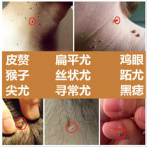 Miquin topical Mote cream 5% flat warts filamentous wart quiniferous membrane mold soft medicine plaster cream flagship store