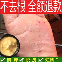Lis beriberi ointment root root root removal artifact foot skin Japanese anti-fungal foot crack dry foot peeling special bacteriostasis