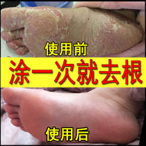 Treatment of beriberi to Root artifact foam foot medicine package sterilization radical treatment of itching hands and feet peeling small water bubble spray nemesis