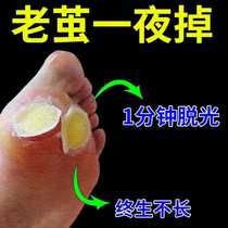 Cocoon dead skin feet thick cocoon calluses corncoons removal of artifact spines feet Cocoon salvage plantar warts