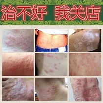Psoriasis seedling ringworm king psoriasis granules for external use eczema antipruritic net root fungal infection cream