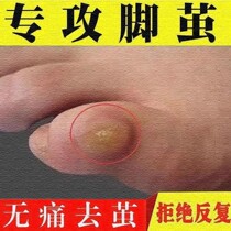 Foot dead skin calluses soles of feet removal of hand calluses hard skin cocoon softener toe joints cocoon artifact