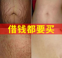 Stretch marks postpartum repair cream Day Fat lines tighten belly Pregnancy Renchen lines dilute This pregnant woman