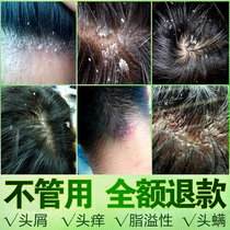  Anti-dandruff anti-itching shampoo Kangwang oil control in addition to mites to remove severe dandruff medicine anti-itching special medical artifact